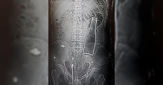 Makatından sokulan soda şişesi ameliyatla çıkarıldı