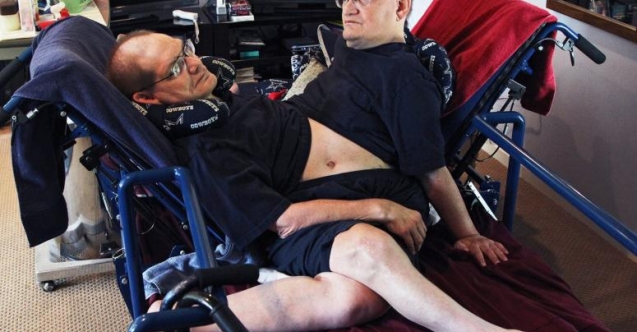 Dünyanın en uzun hayatta kalan yapışık ikizleri 68 yaşında öldü